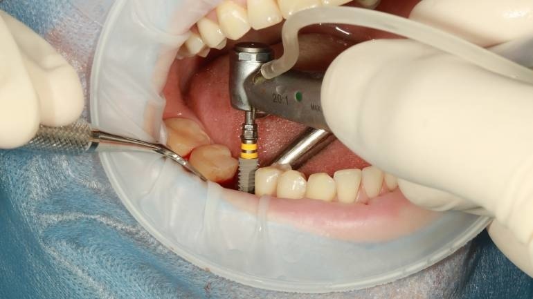 Clínica de Odontologia abre vagas para implantes dentários a preço diferenciado