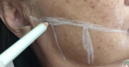Oportunidade para quem quer fazer harmonização facial