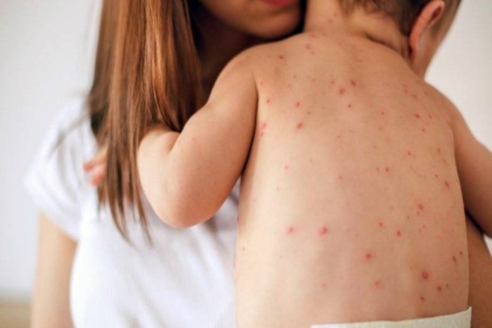 Crianças de seis meses a um ano devem ser vacinadas contra sarampo