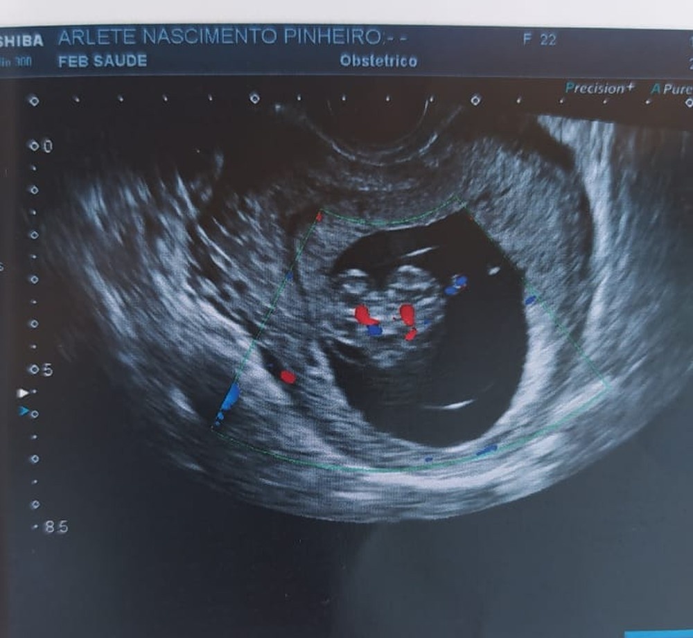 Em MT, grávida de gêmeos siameses vive angústia por não saber se filhos vão sobreviver