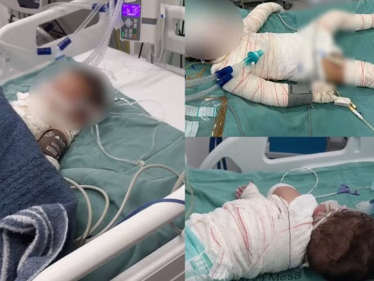 Churrasqueira acesa com álcool explode e deixa mãe e filhos em estado grave em Cuiabá