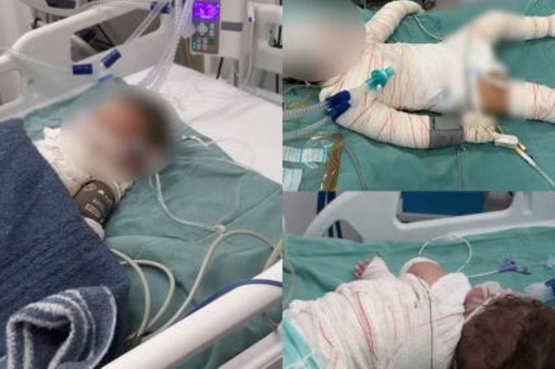 Bebê atingido por explosão morre com queimaduras de 3º grau