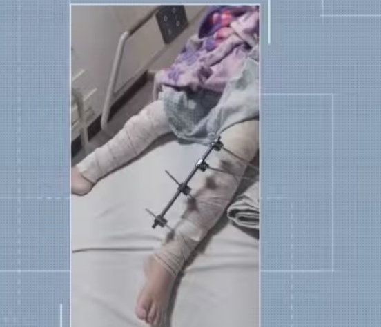 Médicos se enganam e operam perna errada de uma menina de 6 anos na Paraíba