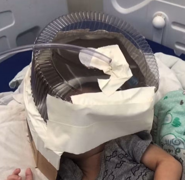Hospital usa embalagem de bolo como máscara de oxigênio em bebê de 3 meses que esperava UTI no RN