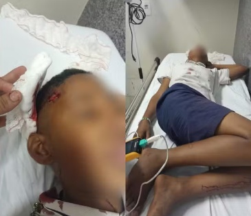 Menino de 11 anos tem crânio rachado após ser agredido com paulada em escola de MT