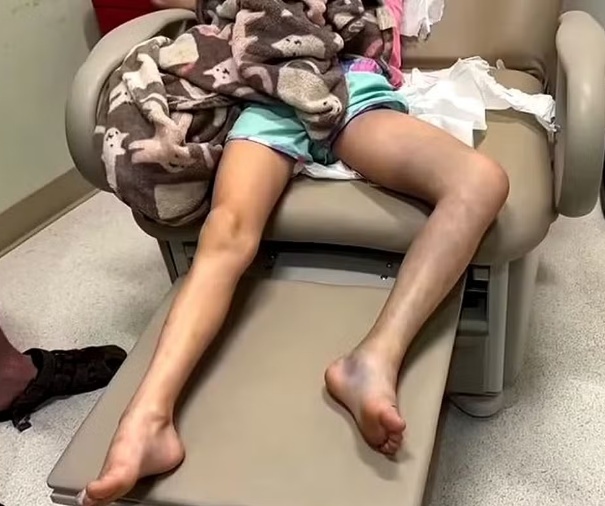Médicos tratam roxo como torção, e menina fica 30h com veneno de cascavel na perna