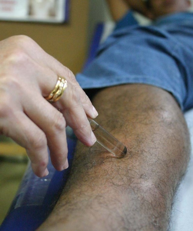 Mato Grosso lidera casos de hanseníase no Brasil; saiba como prevenir