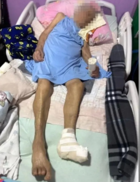 Idosa de 103 anos tem pé amputado por enfermeira sem anestesia