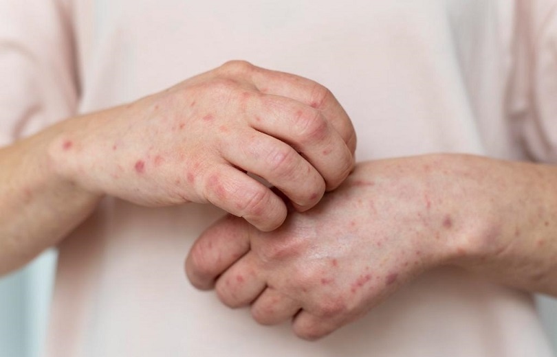 Saúde confirma primeiro caso de nova cepa de mpox no Brasil