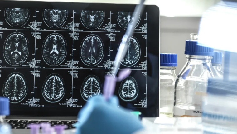 Novo tratamento pode controlar sintomas de Alzheimer, mostra estudo
