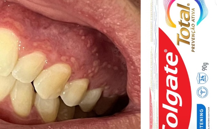 Anvisa interdita linha de cremes dentais da Colgate após lesões bucais em consumidores