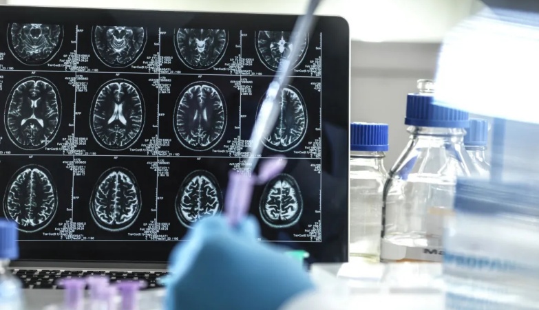 Anvisa aprova 1º tratamento que promete retardar Alzheimer