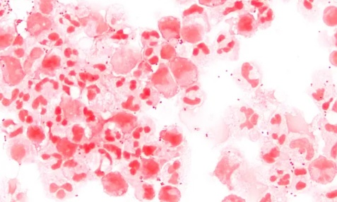 MT registra 27 casos de meningite e seis mortes