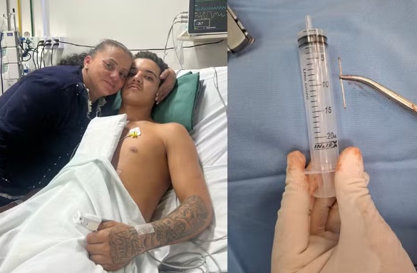 Sem querer, jovem dispara pistola de pregos no próprio coração e sobrevive em SC