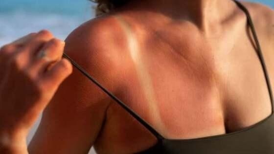 Mulher é demitida após fazer bronzeamente artificial durante atestado