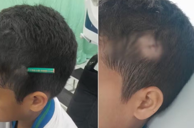 Estudante crava lápis na cabeça de colega após briga dentro de escola no litoral de SP