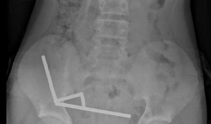 Adolescente perde parte do intestino após engolir mais de 80 imãs