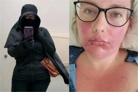''Tenho que viver como uma vampira'', diz mulher com alergia ao sol