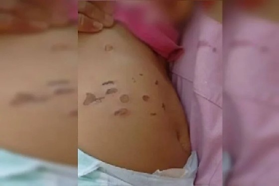 Bebê de 10 meses é vítima de queimaduras por cigarro