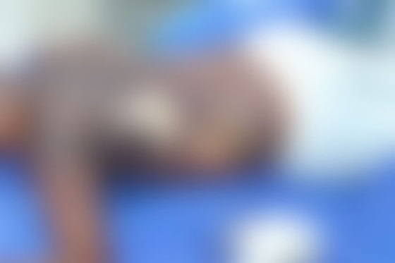 Sorriso: Adolescente tem corpo queimado com gasolina após ir brincar com amigos