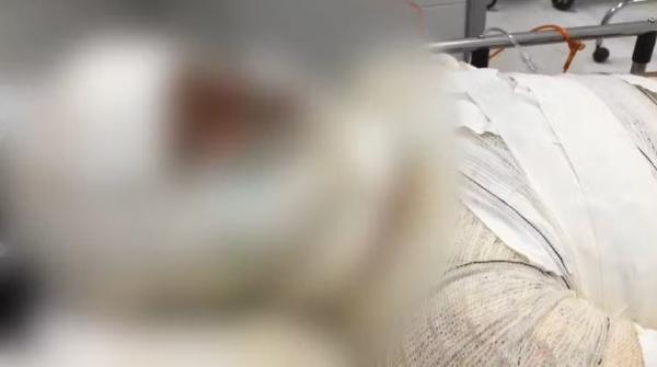 Menina é agredida, queimada e internada em estado grave em hospital de Vitória