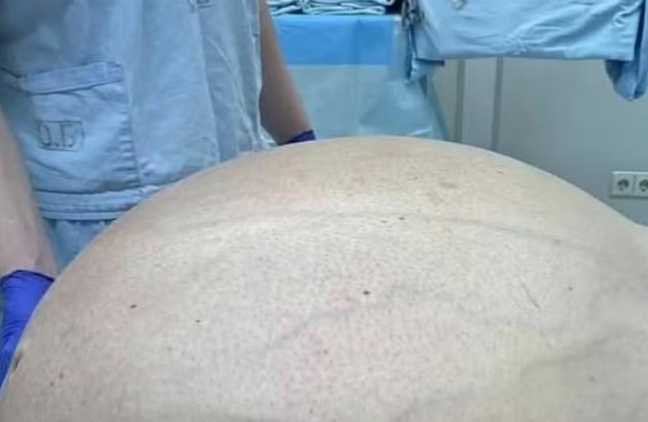 Equipe médica russa retira tumor gorduroso de quase 60 quilos de paciente com 50 anos