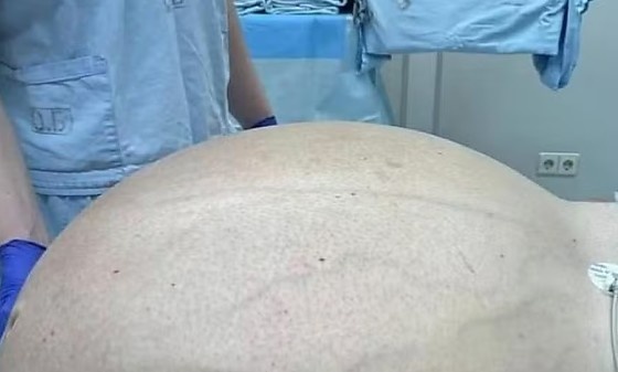 Equipe médica russa retira tumor gorduroso de quase 60Kg