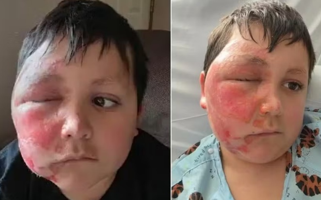 Menino fica com o rosto deformado após participar de desafio no TikTok