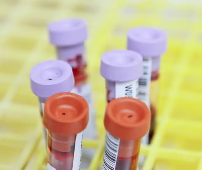 Teste criado por brasileiros pode revolucionar tratamento de esclerose múltipla