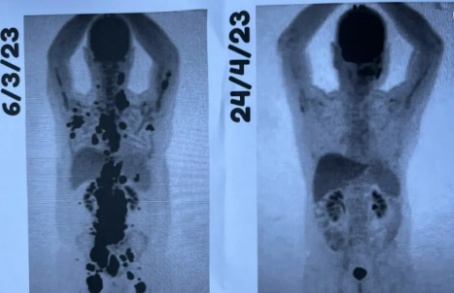 Paciente comemora remissão total do câncer após CAR-T Cell: 'Auge de uma luta de 13 anos'