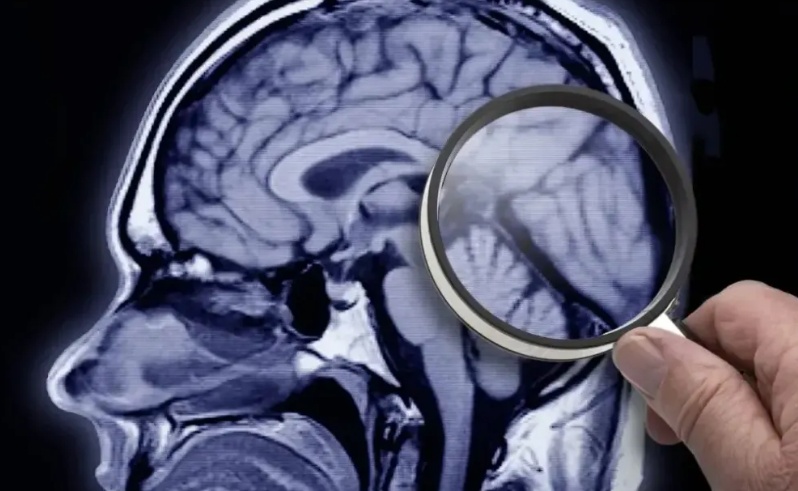 Estudo identifica proteína que acelera desenvolvimento do Alzheimer