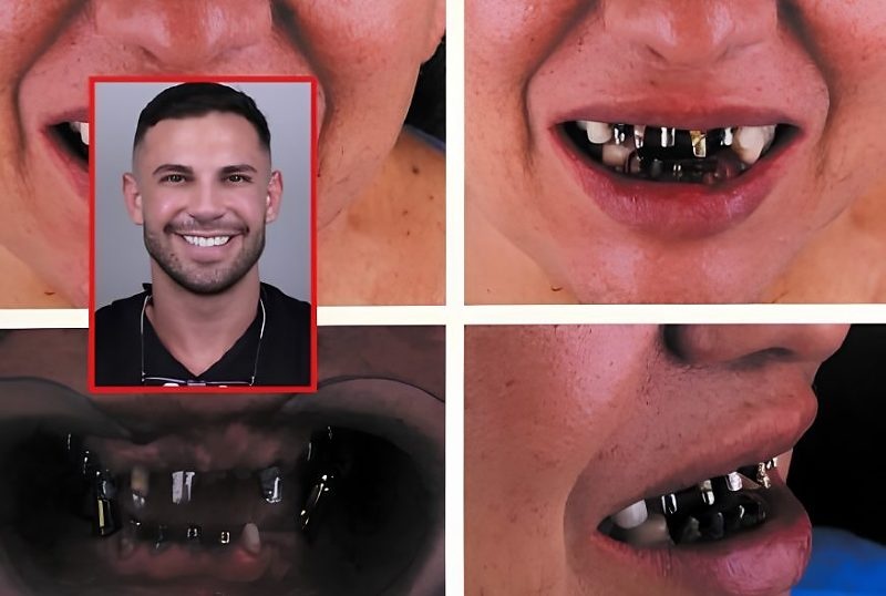 Justiça condena dentista de Cuiabá a pagar indenização a paciente por erro em implante de lentes de porcelana