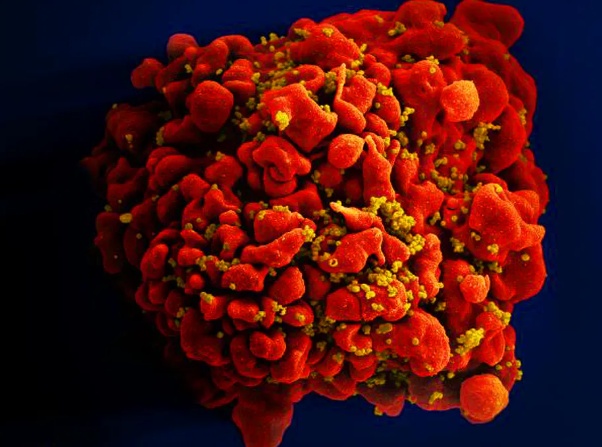 HIV: dois novos casos de cura são anunciados; total chega a 13